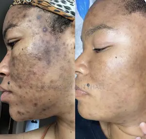 Dark Sports and Hyperpigmentation Treatment