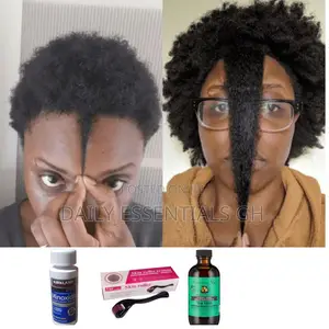 Kirkland Minoxidil, Tea Tree With Derma Roller Combo for Hair Growth