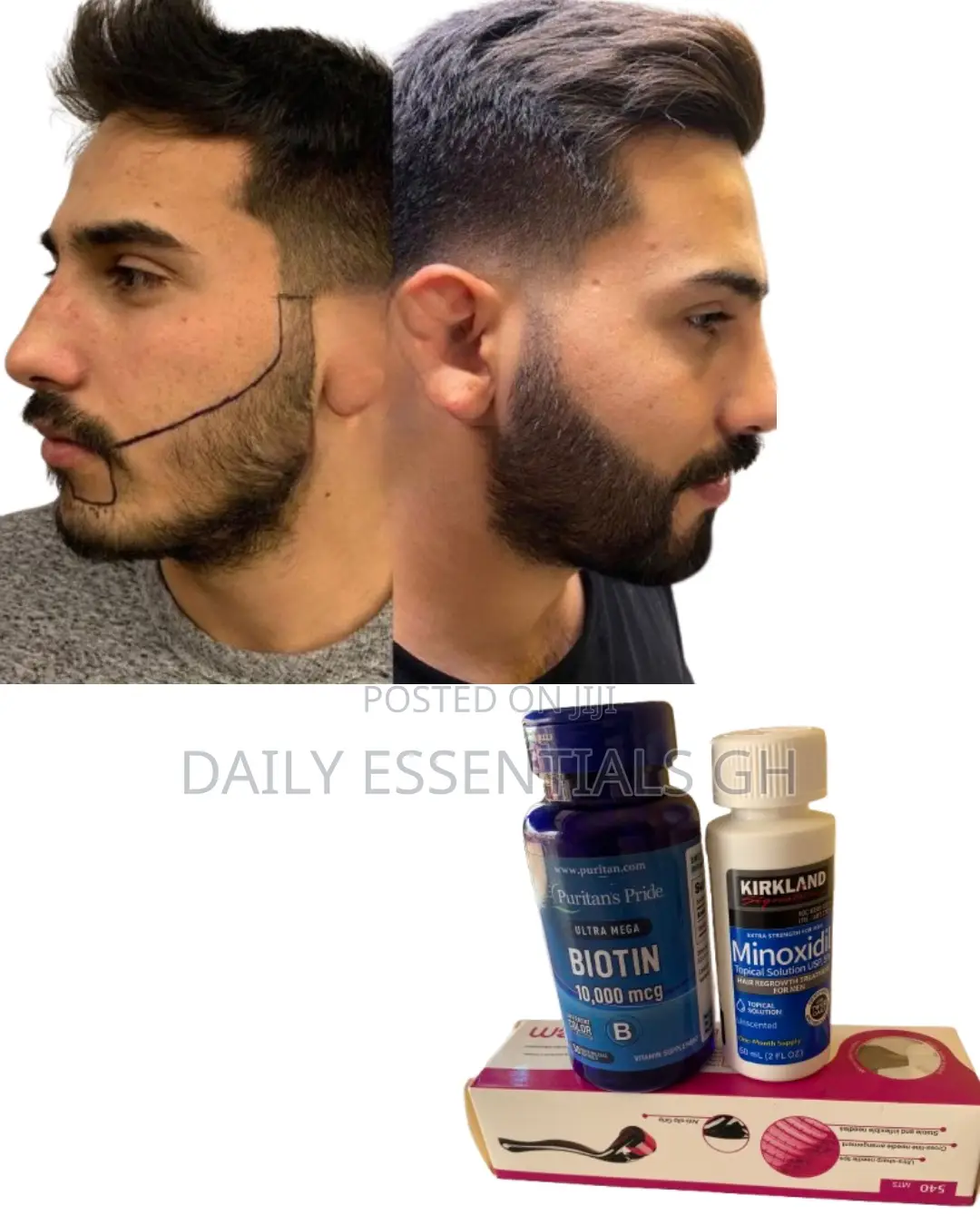Kirkland Foam + Biotin + Roller – Hair Restoration Combo