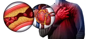 Heart Attack Stroke Remedy