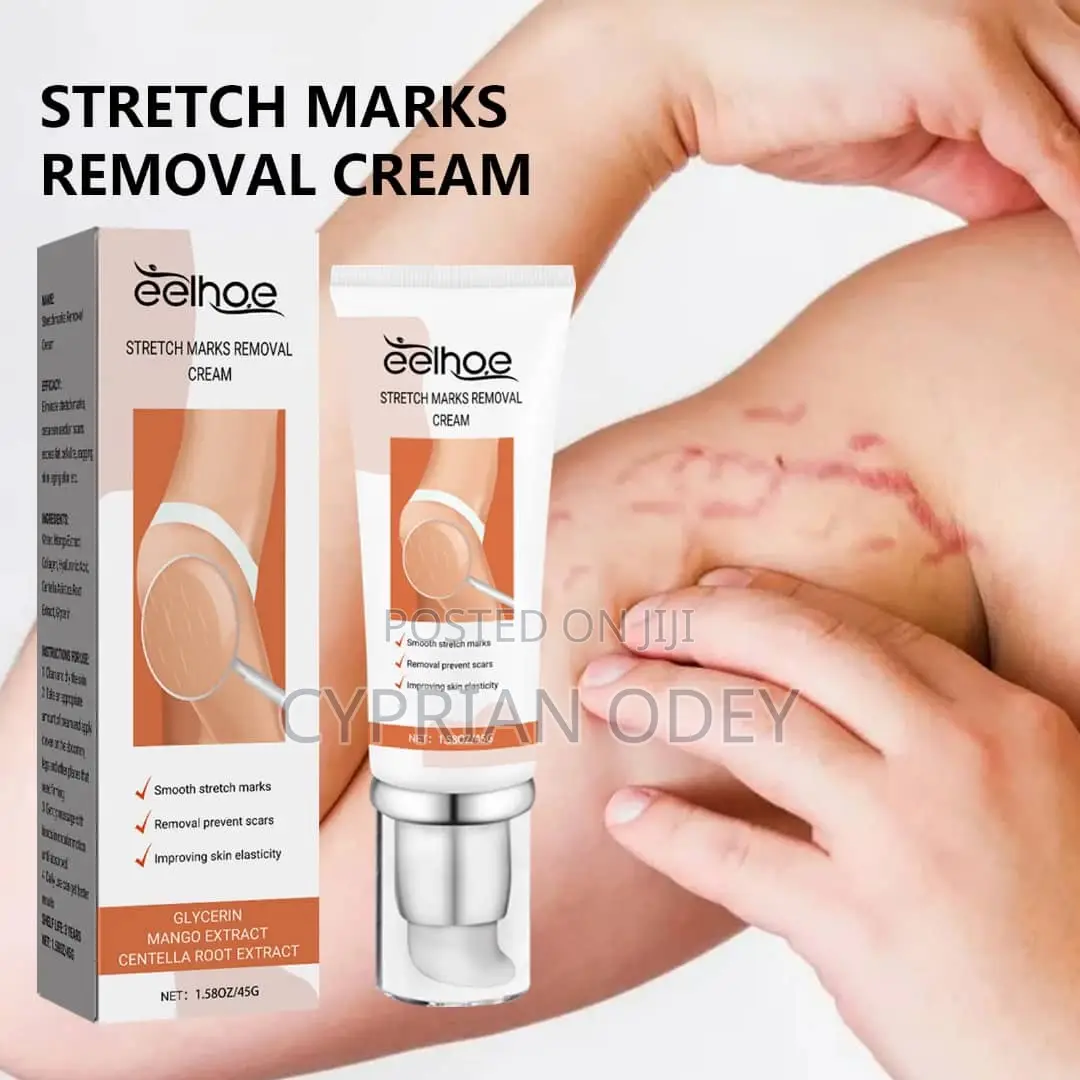 Stretch Mark Removal Cream