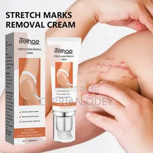 Stretch Mark Removal Cream
