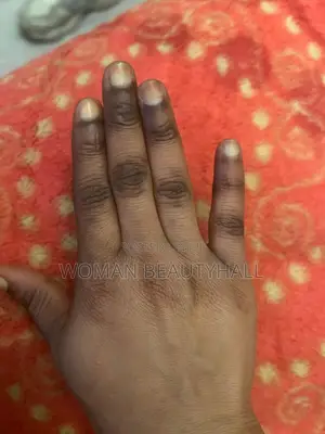 Dark Knuckles Laser Treatment