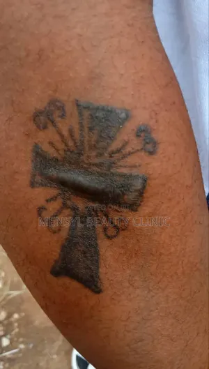 Tattoo Removal