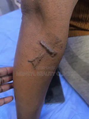 Tattoo Removal