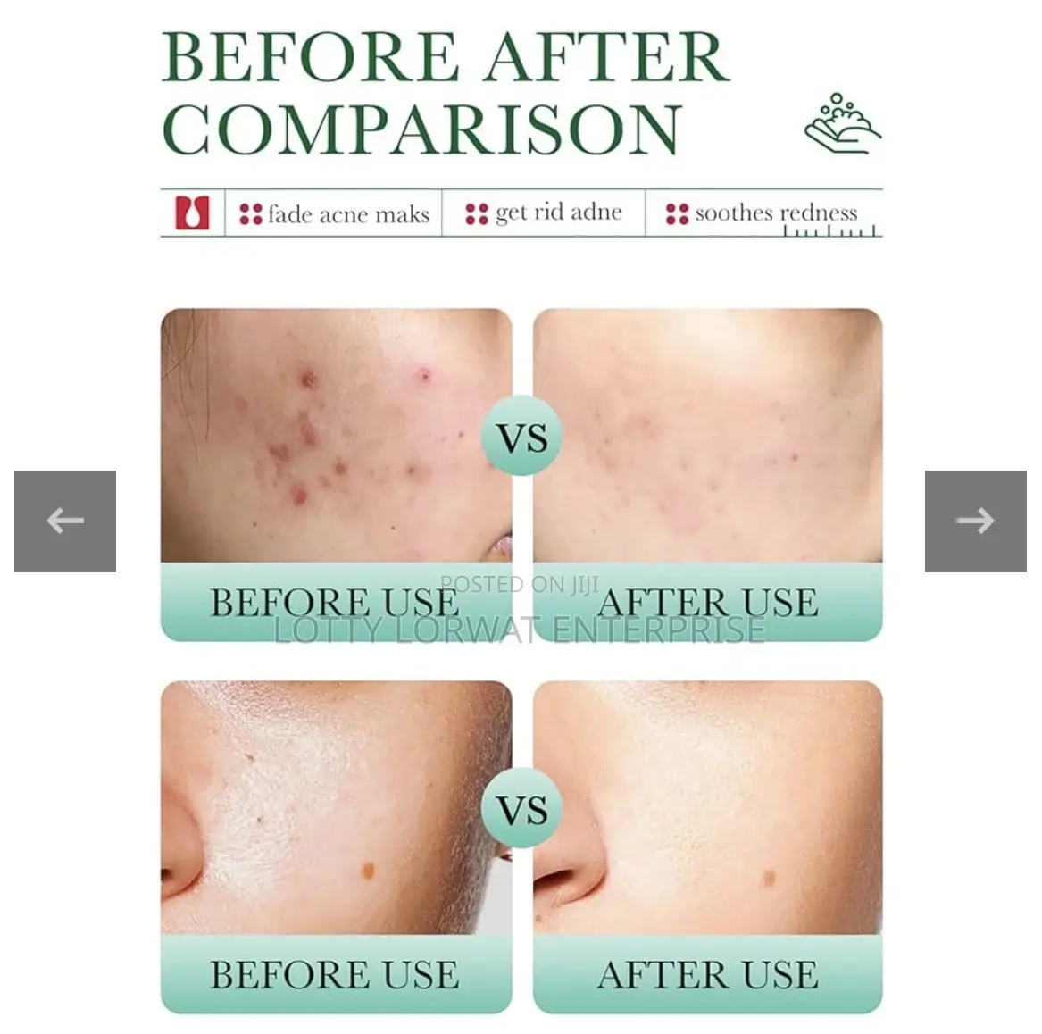 Acne Removal Set