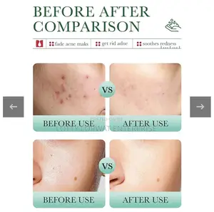 Acne Removal Set