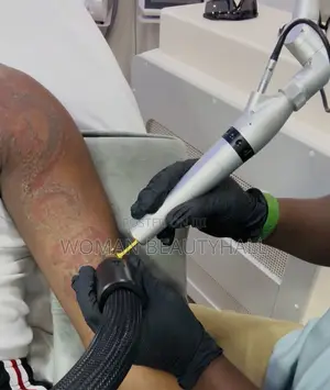 Advance Pico Way Laser Tattoo Removal