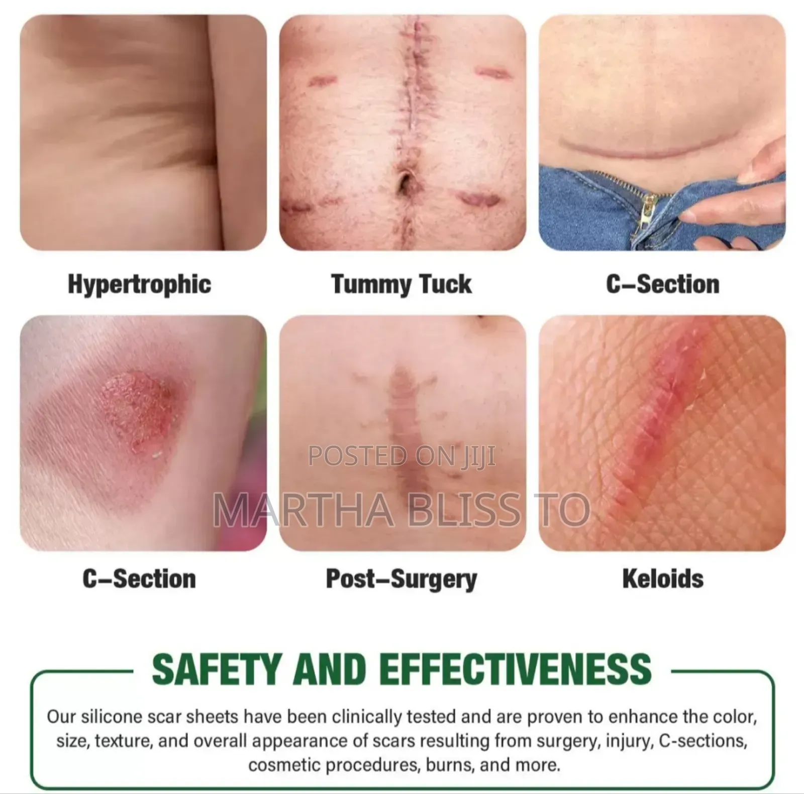 Silicone Scar Sheet