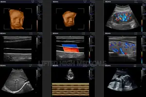 Edan Acclarix Ax3 Portable Color Doppler Ultrasound