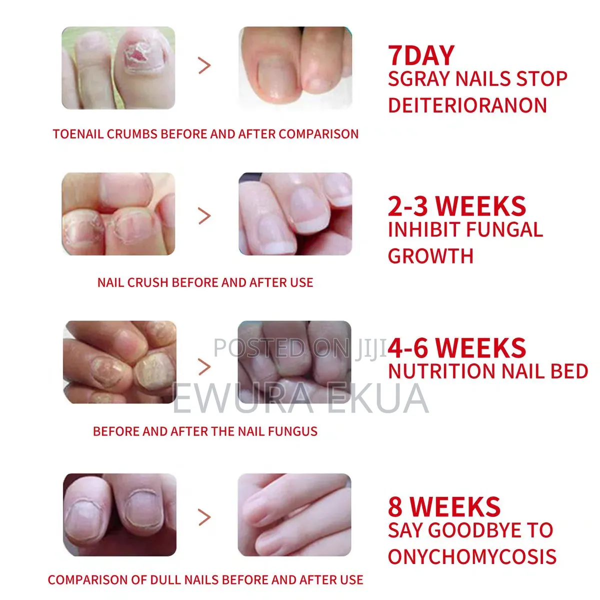 Anti Fungal Nail Treatment( Maximum Strength)