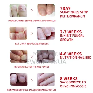 Anti Fungal Nail Treatment( Maximum Strength)