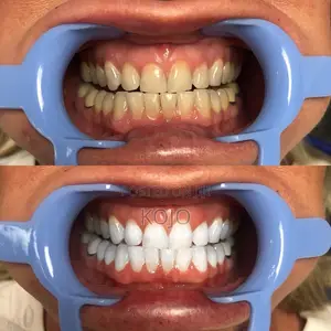 Teeth Whitening