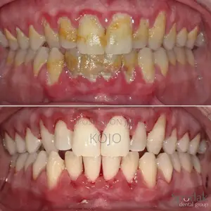 Teeth Cleaning
