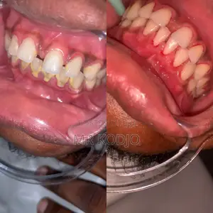 Teeth Cleaning