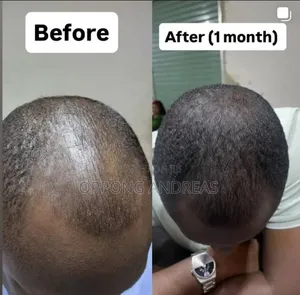 6 in 1 Kirkland Minoxidil 5% Extra Strength Hair Regrowth Solution
