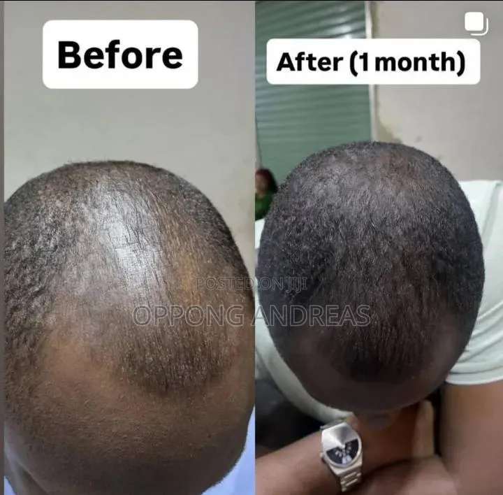 6 in 1 Kirkland Minoxidil 5% Extra Strength Hair Regrowth Solution