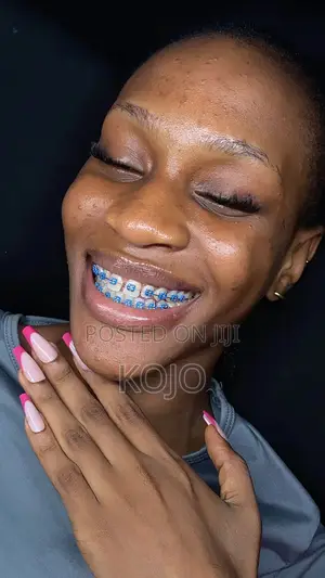 Teeth Braces