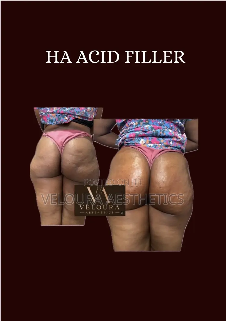 Non-Surgical BBL Fillers | Hip Dip Enhancement | Accra