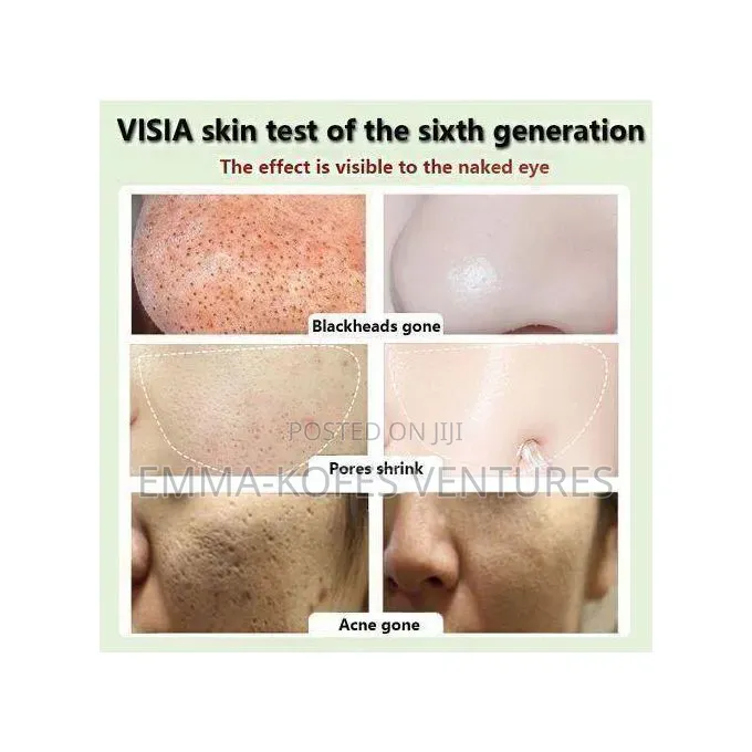 Green Mask Stick for Pimples
