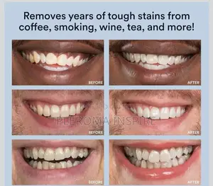 Teeth Whitening Kit, Peroxide Teeth Whitening Gel,