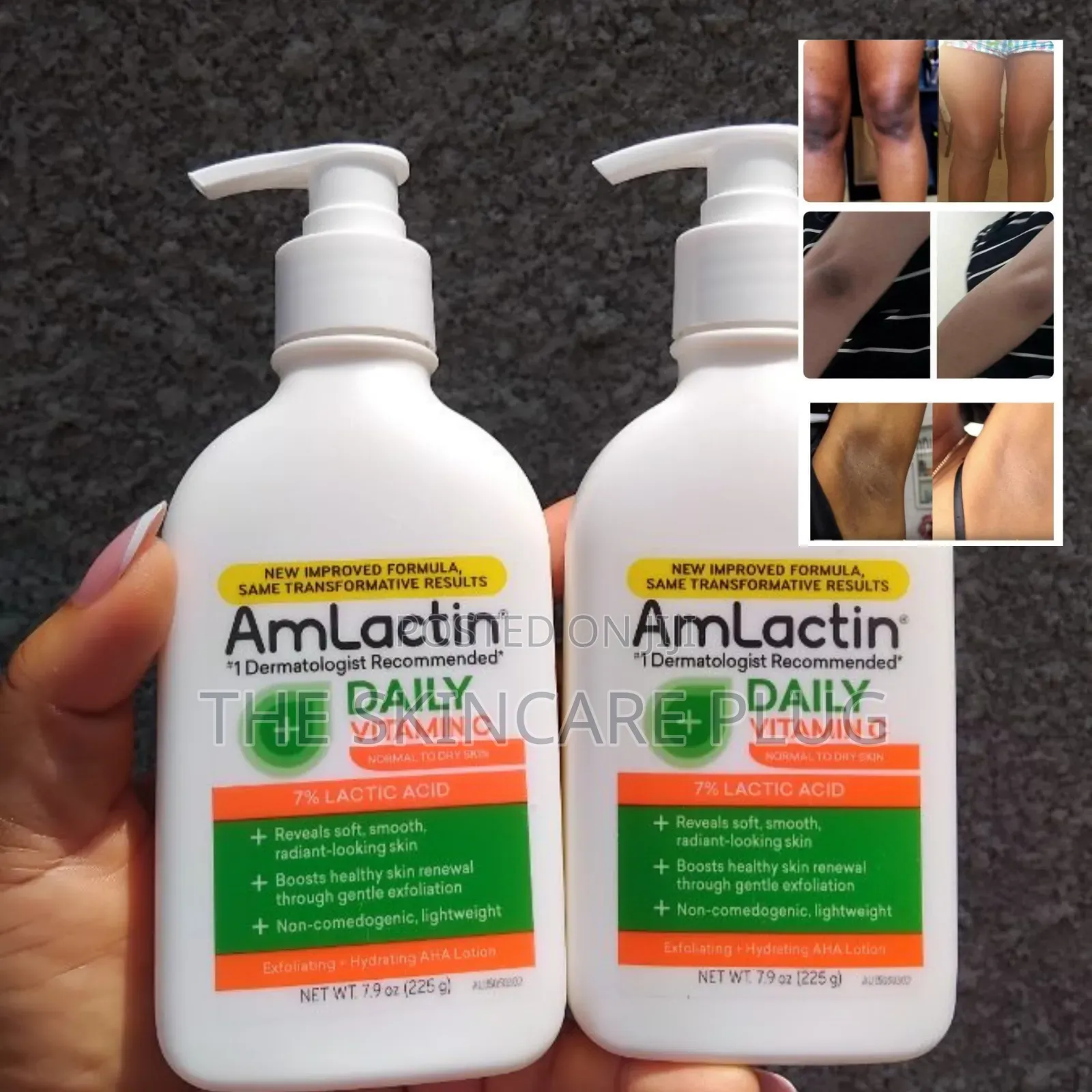 Amlactin Vitamin C Body Lotion With 7% Lactic Acid